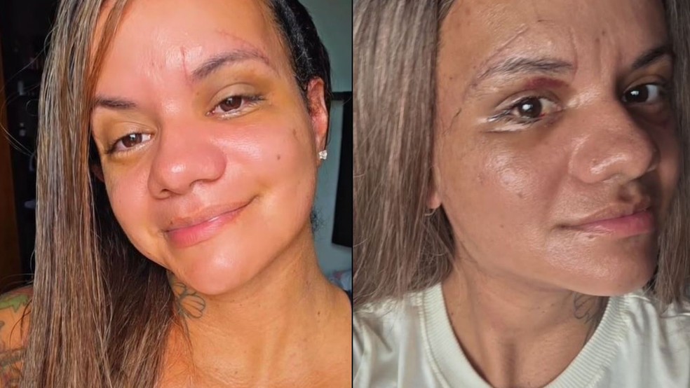 Juliana Soares fala sobre recuperação após cirurgia de reconstrução facial no RN — Foto: Reprodução