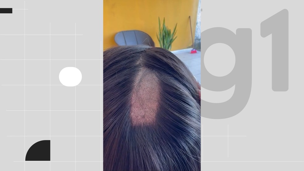 Cabeça da mulher foi raspado duas vezes durante o procedimento — Foto: Reprodução/Instagram