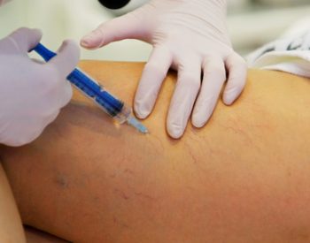 Tratamento de varizes-por escleroterapia. ( Foto: Assessoria )