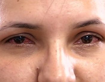 Olhos vermelhos e lacrimejantes são sintomas da conjuntivite (Foto: Reprodução/TV Anhanguera)
