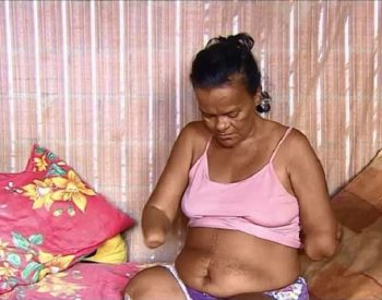 Após complicação em uma cirurgia, ex-sinaleira teve infecção generalizada e todos os membros de seu corpo foram amputados — Foto: Reprodução.