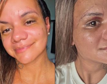 Juliana Soares fala sobre recuperação após cirurgia de reconstrução facial no RN — Foto: Reprodução