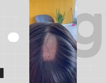 Cabeça da mulher foi raspado duas vezes durante o procedimento — Foto: Reprodução/Instagram