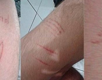 Jovem demontra marcas de corte provocado pelo decorrer do jogo da Baleia Azul.