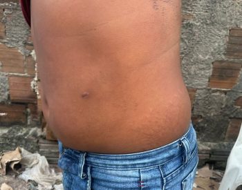 Marca da saída da bala na barriga do adolescente de 12 anos baleado durante briga de trânsito — Foto: Kleber Teixeira/Inter TV Cabugi